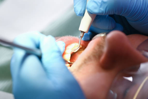 Best Emergency Root Canal Treatment in Kettering, MD