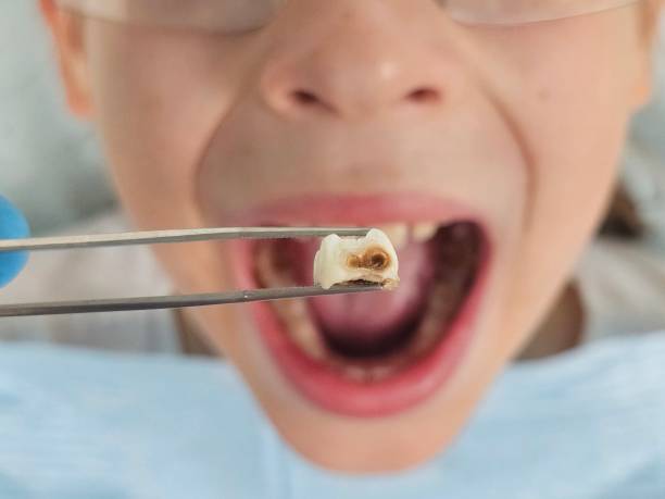 Best Emergency Tooth Extraction in Kettering, MD